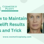 Facelift Results