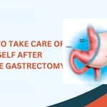 Sleeve Gastrectomy