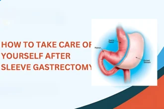 Sleeve Gastrectomy